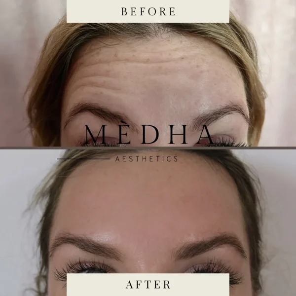 Before and after forehead wrinkle treatment.