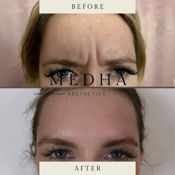 Before and after frown line treatment
