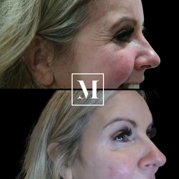 Side profile before and after cosmetic treatment.