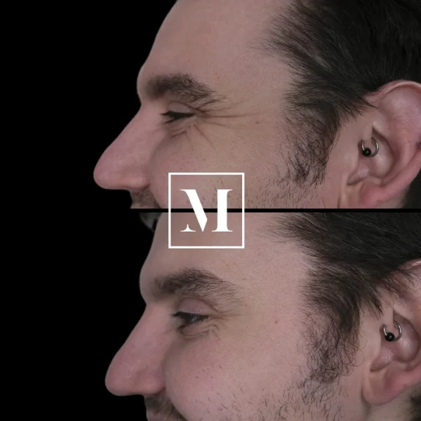 Before and after rhinoplasty comparison