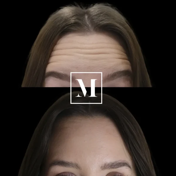 Forehead wrinkles before and after treatment