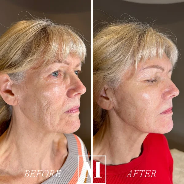 Before and after beauty treatment comparison