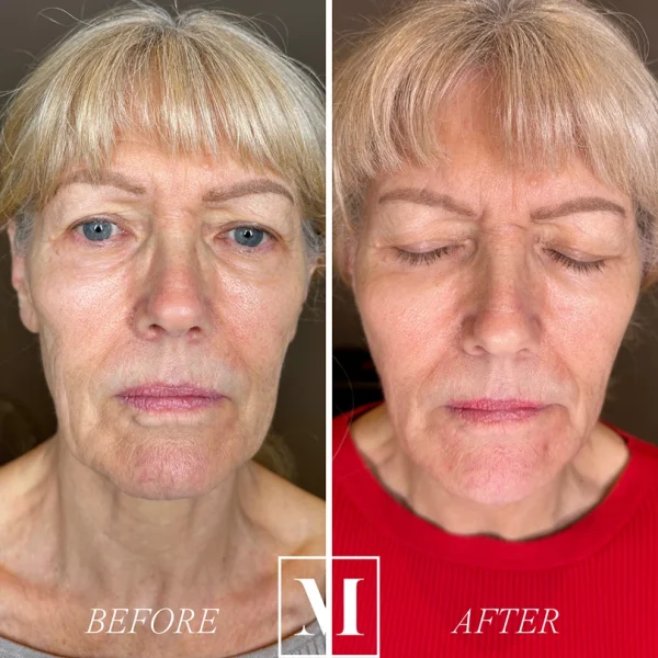 Before and after anti-aging treatment