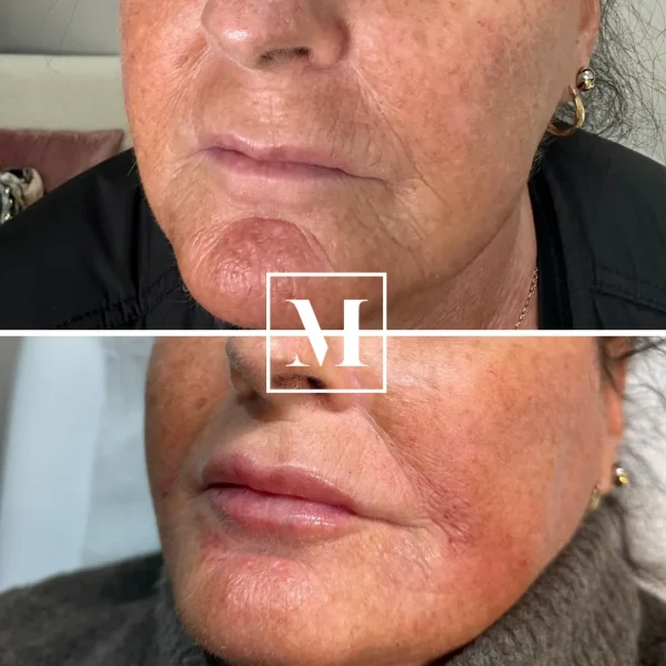 Before and after facial treatment comparison.