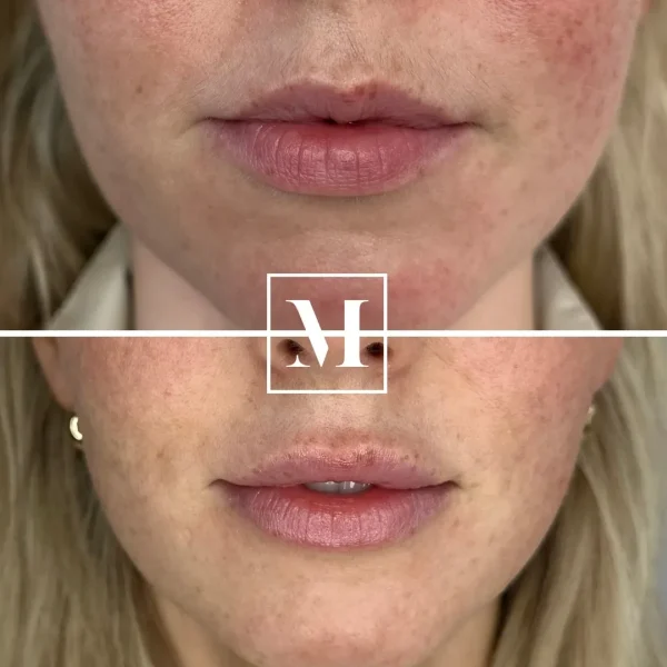 Before and after lip filler treatment.