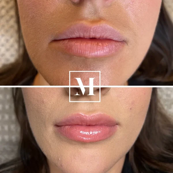 Before and after lip enhancement