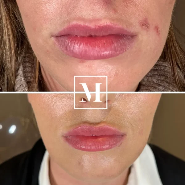 Before and after lip enhancement