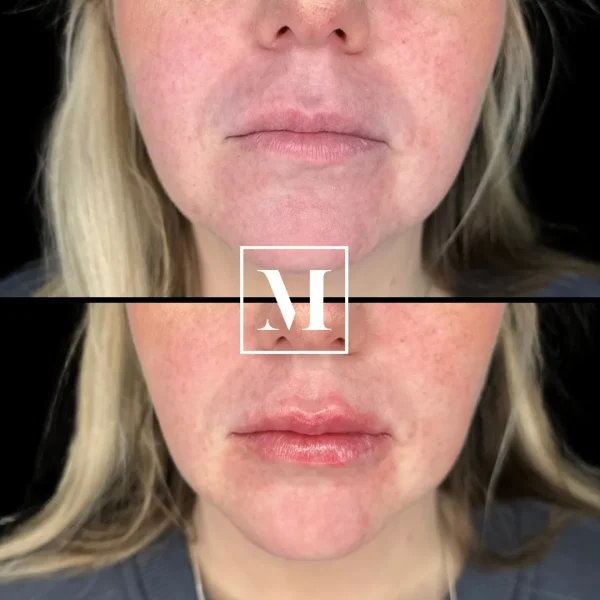 Before and after lip enhancement