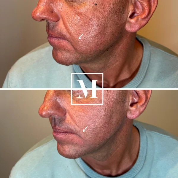 Male face acne scar before and after treatment