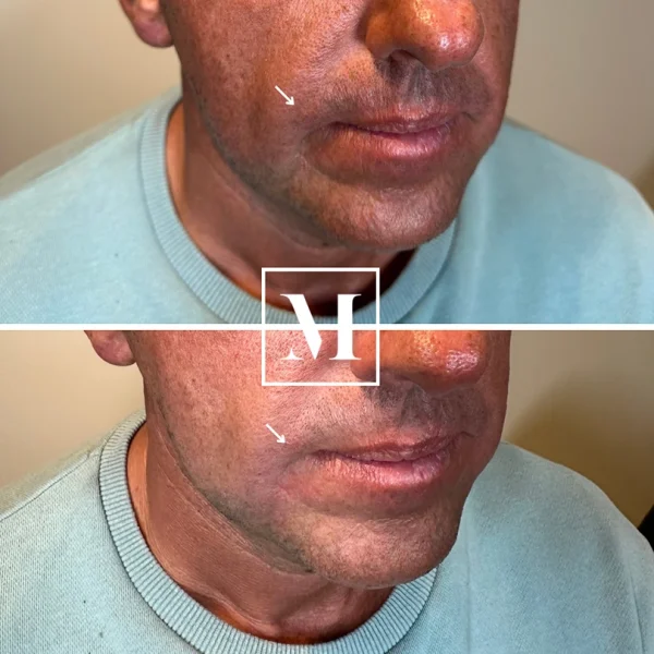 Lip filler before and after transformation.