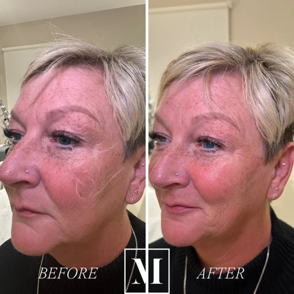 Before and after cosmetic treatment on woman's face.