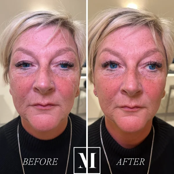 Before and after face treatment comparison of a woman.