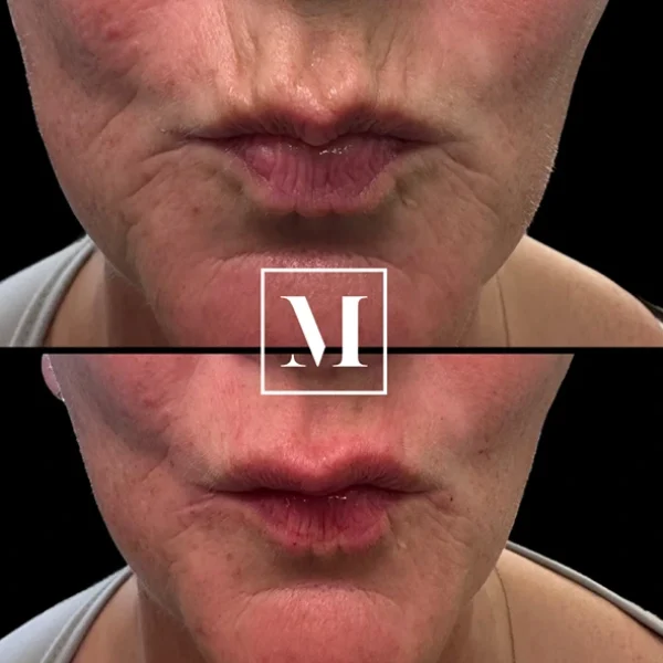 Before and after lip treatment comparison.