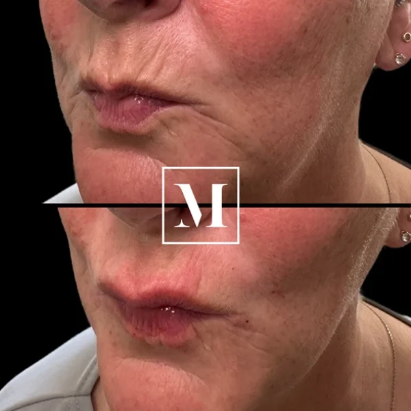 Before and after lips enhancement comparison