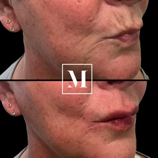 Before and after skin treatment comparison