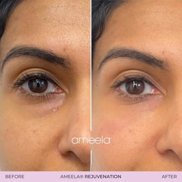 Before and after Ameela rejuvenation treatment