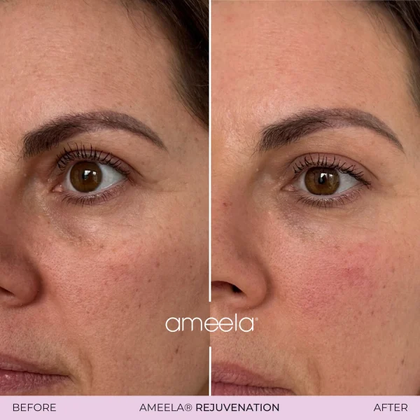 Before and after Ameela rejuvenation results.