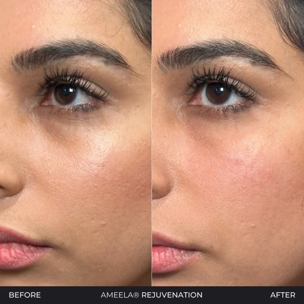 Before and after Ameela Rejuvenation