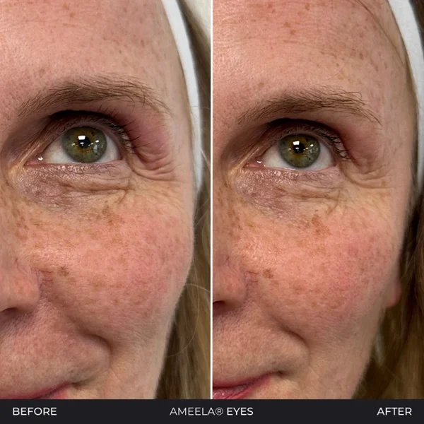 Before and after eye treatment comparison