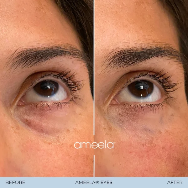 Before and after Ameela® Eyes treatment