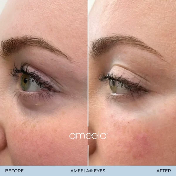 Before and after AMEELA® Eyes treatment results.