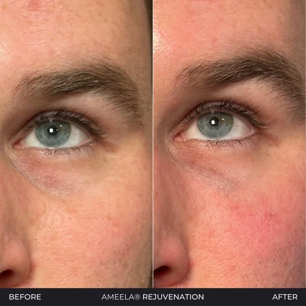 Before and after Ameela® Rejuvenation close-up