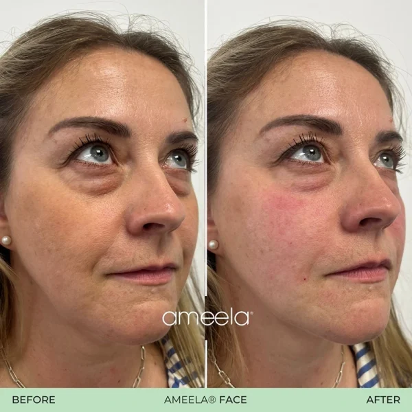 Ameela face before and after treatment.