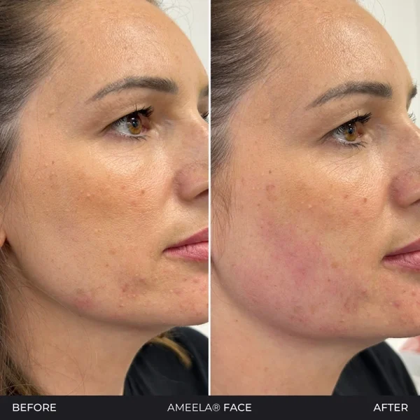 Before and after face treatment comparison.