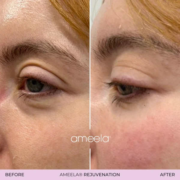 Ameela rejuvenation eye treatment before and after photos.