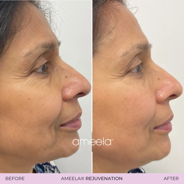 Before and after AMEELA rejuvenation treatment.