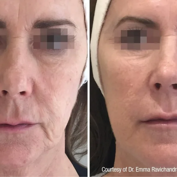 Before and after skin treatment comparison.