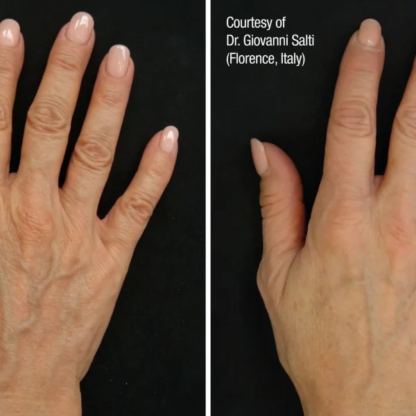 Before and after hand rejuvenation.