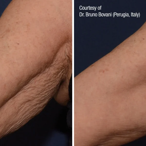 Arm skin before and after treatment