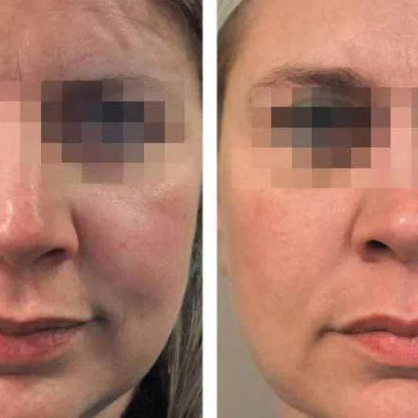 Before and after facial treatment comparison.