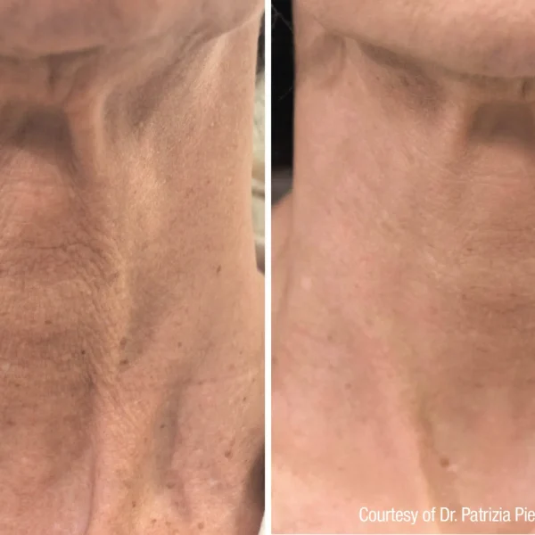 Neck before and after treatment