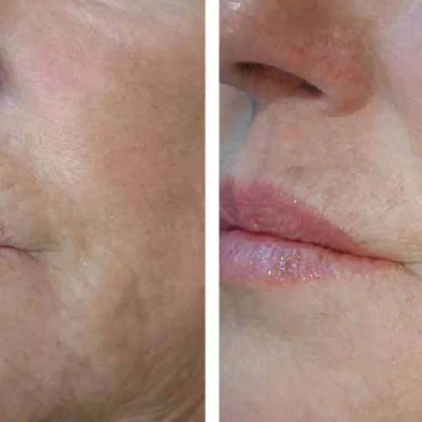 Before and after skin treatment comparison.